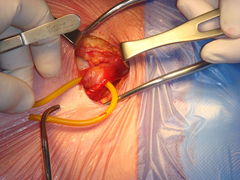 Cirugía hernia inguinal